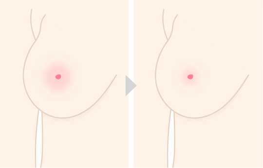 乳輪縮小とは