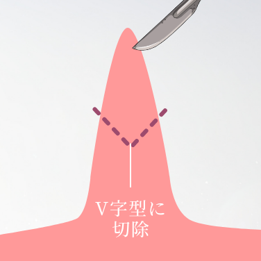 V字切除法による自然な仕上がり