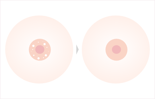 乳輪縮小とは