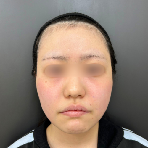 after