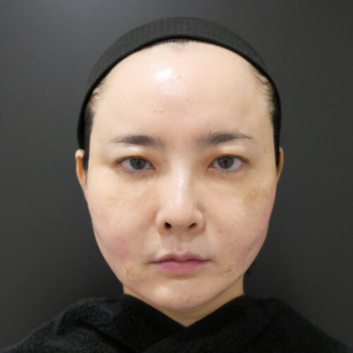 after